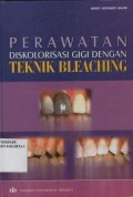 Perawatan Diskolorisasi gigi dengan teknik bleaching