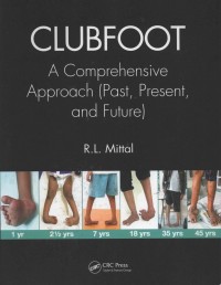 Clubfoot : A Comprehensive Approach (Past, Present, and Futur)